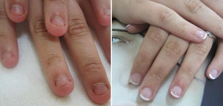 antes y despues de uñas