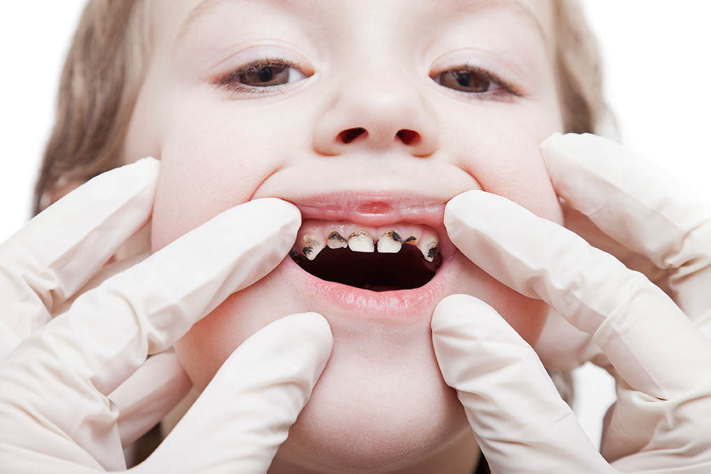 Tanto niñoscomo personas maduras,son los mas vulnerables de que sufran caries