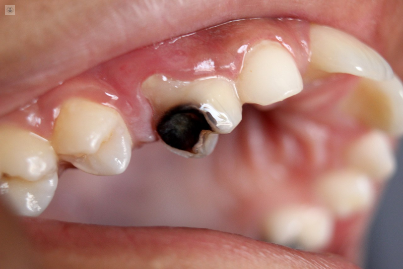 Saber lo peligroso que es para nuestros dientes el sufrir de caries 