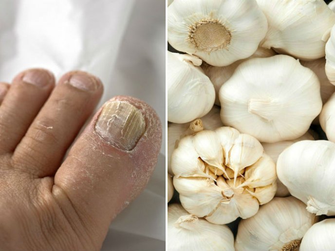 El Ajo como remedio  casero para hongos en las uñas de los pies